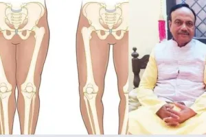 लखनऊ : बच्चों के विकास में जल्दबाजी से बचें, जानिये कितना खतरनाक है वॉकर का इस्तेमाल