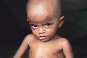 बदायूं: अतिकुपोषित बच्चों की होगी पहचान, मिलेगा विशेष पोषण