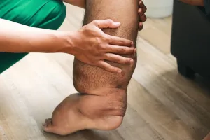 UP के 27 जिलों में फाइलेरिया अभियान शुरू, 195 ब्लॉक में खिलाई जाएगी दवा 