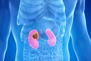 Noida News: किडनी ट्यूमर से बच्चों को बचाने के लिए चाइल्ड PGI कर रहा है रिसर्च