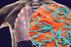 टीबी बीमारी से होने वाली मौतें अब जल्द होंगी कम! नया ‘डिफ्रेंशिएटेड केयर’ मॉडल ला रहा क्रांति