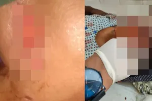 अमेठी : शुकुल बाजार में आवारा कुत्तों के आतंक से ग्रामीणों में दहशत, दो दिनों में 50 लोगों को बनाया निशाना