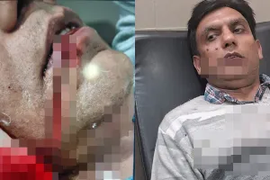 अब चाइनीज मांझे की धार से रिटायर्ड सैन्यकर्मी की चेहरा कटा... राहगीरों ने पहुंचाया अस्पताल, 2017 से प्रतिबंधित है ये मांझा