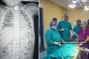 UP News: तीन साल के मासूम ने निगला पांच रुपये का सिक्का, डॉक्टरों ने बिना ऑपरेशन दो घंटे में निकाला