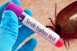 Scrub Typhus Alert: सिर्फ बुखार नहीं, लिवर और किडनी को भी गंभीर नुकसान पहुंचा सकता है स्क्रब टायफस, KGMU-PGI शोध में बड़ा खुलासा