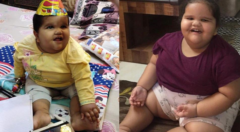 उम्र 2 साल, वजन 45 किलो और बन आई मासूम की जान पर, मगर चिकित्सकों ने नहीं मानी हार…