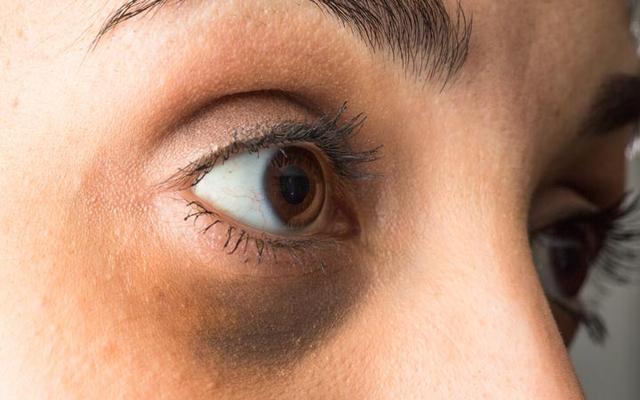 अगर हो गए हैं Dark Circles तो इन घरेलू उपायों से पाएं छुटकारा