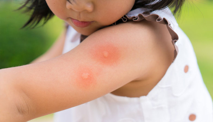 Health Care : मच्छरों के काटने से ऐसे करें बचाव, अपनाएं ये घरेलू तरीके