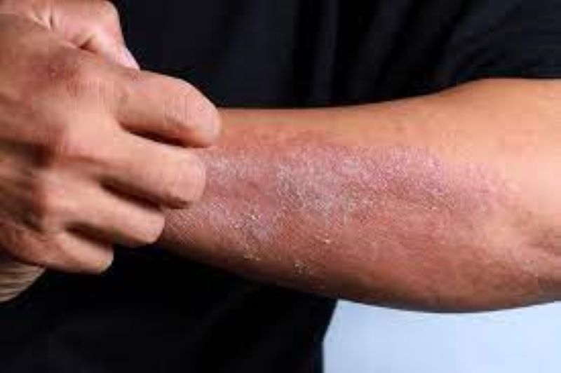 हल्द्वानी: बेस अस्पताल में इलाज को भटक रहे त्वचा रोगी