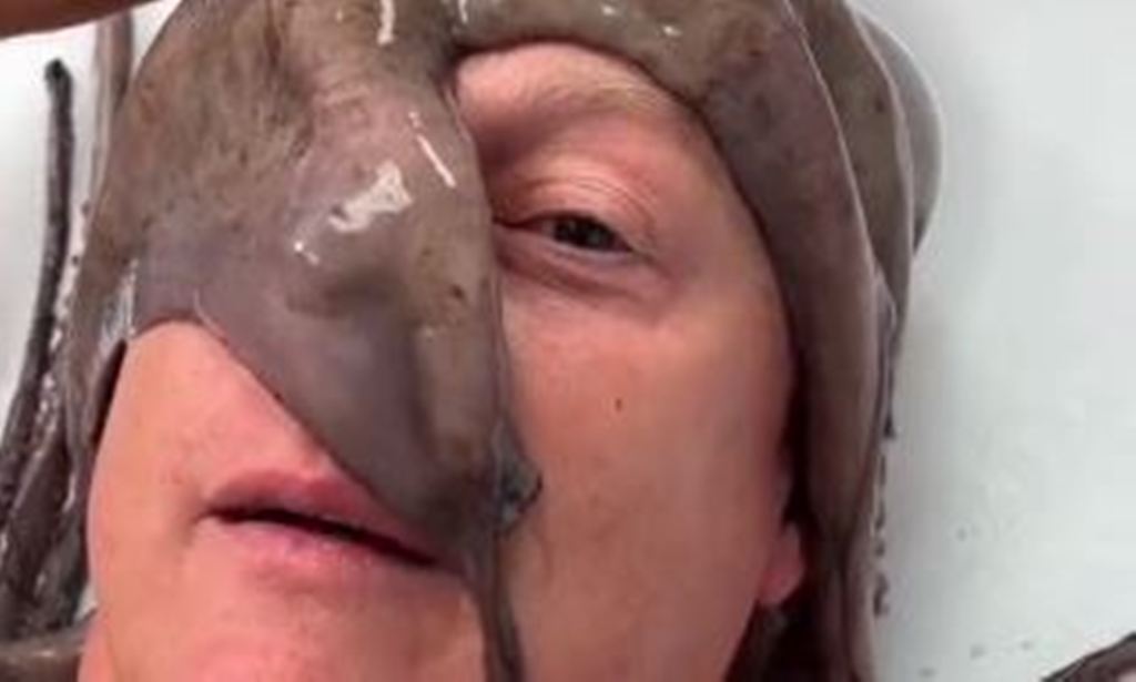 VIRAL VIDEO: शख्स के चेहरे और सीने पर चिपका ऑक्टोपस, हटाने में डॉक्टर्स के छूटे पसीने, वीडियो देख कांप जाएगी रूह 