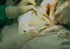 लखीमपुर-खीरी: जिला अस्पताल में सर्जन ने निकाला महिला के पेट में बैंडेज 