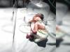 बरेली: जन्म के चंद घंटे के बाद नवजात बच्ची को गन्ने के खेत में फेंका, कीड़े खा गए दोनों पैर