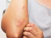 बरेली: गर्मी के प्रकोप ने बढ़ा दिए त्वचा रोगी, करें बचाव