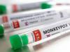 सावधान: Monkeypox से बच्चों को ज्यादा खतरा, लक्षणों पर रखनी होगी कड़ी नजर
