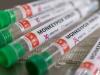 न्यूजीलैंड में मंकीपॉक्स से बचाव के लिए तैयार की ‘टेकोविरिमैट’ दवा, सितंबर के अंत से होगी वितरित
