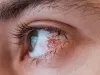 Pink Eye Infection: अपने मासूम बच्चों को बचाएं 'पिंक आई' के संक्रमण से, यह टिप्स अपनाएं