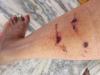 बरेली: सिविल लाइंस में कुत्तों ने महिला को दौड़ाकर काटा, पॉश कालोनी में आतंक से लोग परेशान