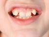 बरेली: बचपन में नहीं दिया ध्यान तो हो सकते हैं टेढ़े-मेढ़े दांत, यह उपाय करें