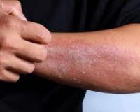 हल्द्वानी: बेस अस्पताल में इलाज को भटक रहे त्वचा रोगी