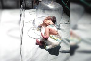 बरेली: जन्म के चंद घंटे के बाद नवजात बच्ची को गन्ने के खेत में फेंका, कीड़े खा गए दोनों पैर