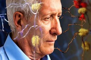 अब हाइपरबेरिक ऑक्सीजन थेरेपी से भी सही हो सकता है अल्जाइमर