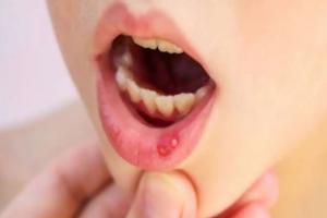Mouth Ulcers: मुंह के छाले कर रहे हो परेशान तो करें ये घरेलू उपाय