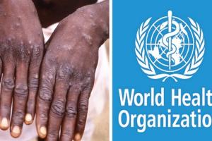 Monkeypox outbreak : डब्ल्यूएचओ ने कहा- मंकीपॉक्स को अभी वैश्विक स्वास्थ्य आपातकाल घोषित करने की जरूरत नहीं