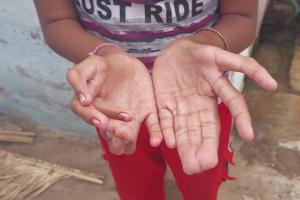 Polydactyly : MP में एक शख्स और 3 बच्चों को दुर्लभ बीमारी, हाथ-पैर में 28 उंगलियां