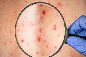 Monkeypox: औरैया में महिला में ‘मंकी पॉक्स’ जैसे लक्षण मिलने से हड़कंप, सैंपल भेजा गया लखनऊ