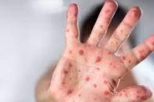 प्रयागराज: मंकीपॉक्स वायरस को लेकर CMO ने कहा- लक्षण दिखने पर ना करें इग्नोर गंभीरता से कराएं इलाज