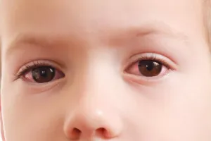 Eye Flu: हल्द्वानी में आई फ्लू से 50 प्रतिशत बच्चों की आंखें 'लाल'