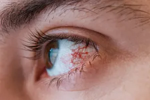 Pink Eye Infection: अपने मासूम बच्चों को बचाएं 'पिंक आई' के संक्रमण से, यह टिप्स अपनाएं