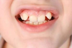 बरेली: बचपन में नहीं दिया ध्यान तो हो सकते हैं टेढ़े-मेढ़े दांत, यह उपाय करें